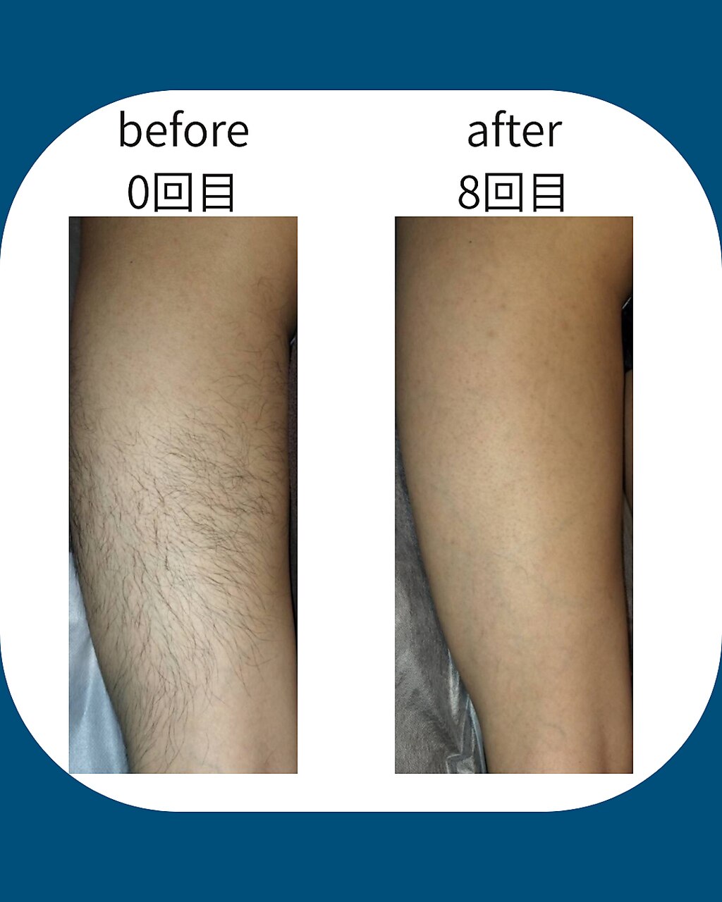 脚脱毛のbefore/afterイメージ